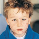 Molluscum contagiosum bei Kindern