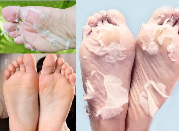 Creme von Schwielen und Hühneraugen
