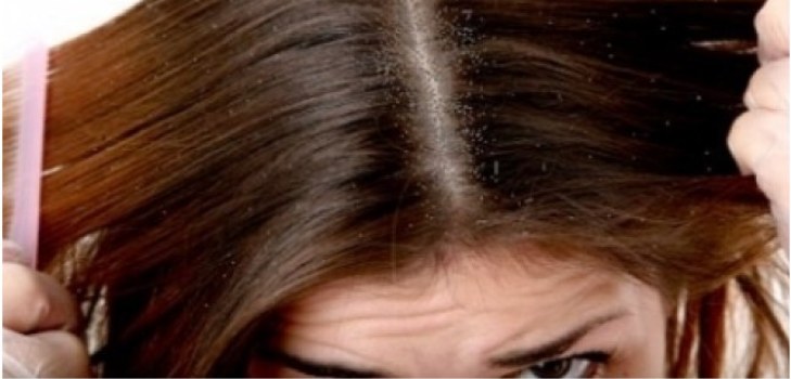 Haare mit Schuppen