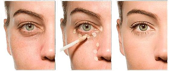 Permanent Make-up zum Verstecken von Prellungen unter den Augen