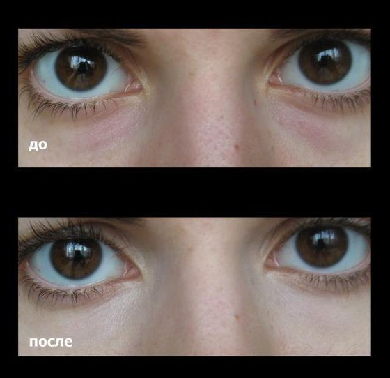 Permanent Make-up zum Verstecken von Prellungen unter den Augen