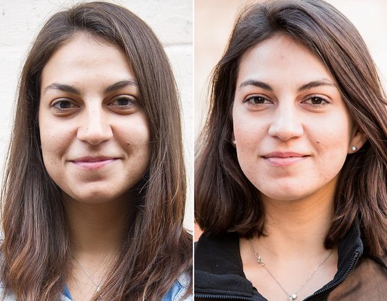 Permanent Make-up zum Verstecken von Prellungen unter den Augen