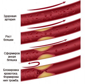 Behandlung von Atherosklerose mit Volksmedizin