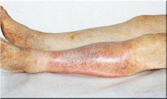 Behandlung von Atherosklerose mit Volksmedizin