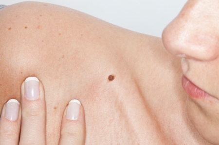 rote Mole auf dem Körper Foto