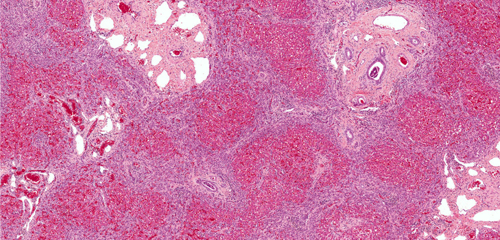 Was ist Fibrose? Symptome, Fotos, Behandlung