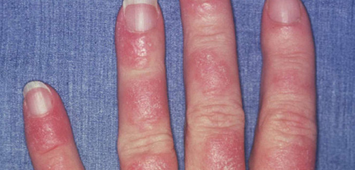 Was ist Lupus? Symptome und Ursachen der Krankheit