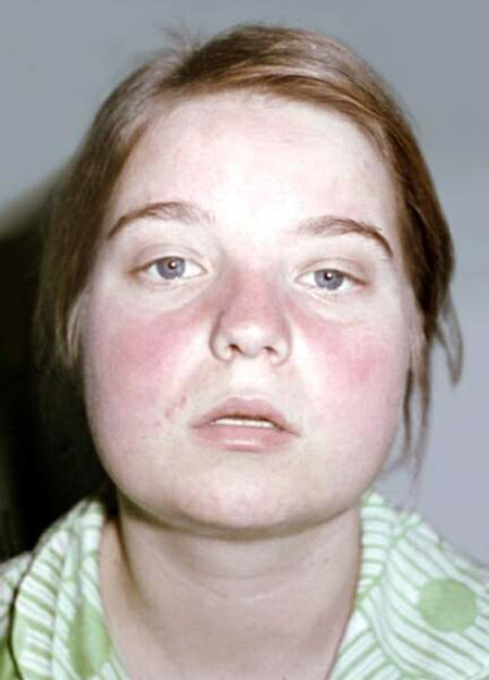 Was ist Lupus? Symptome und Ursachen der Krankheit