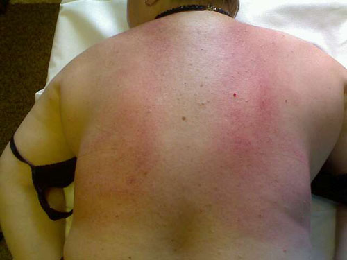 Sollten Prellungen nach der Massage bleiben?