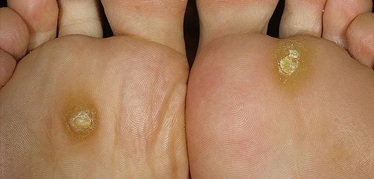 Probleme mit Hühneraugen und Schwielen? Suchen Sie nach der Lösung hier!