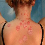 Wie behandelt man Psoriasis? Wie behandelt man Psoriasis?