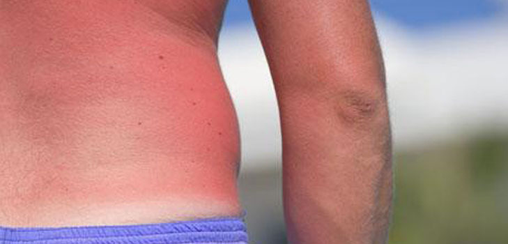 Die Haut ist in der Sonne verbrannt. Was zu tun ist? Rezepte, Masken, Tipps