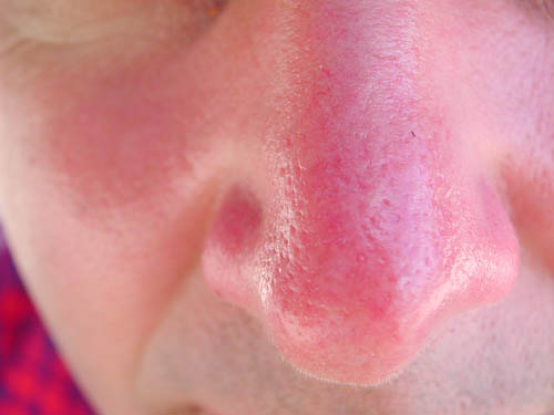 Die Haut ist in der Sonne verbrannt. Was zu tun ist? Rezepte, Masken, Tipps