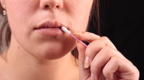Wirksame Wege zur Behandlung von Erkältungen auf den Lippen
