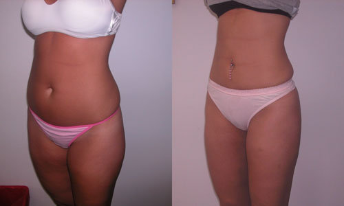 Liposuktion des Bauches und der Oberschenkel: Bewertungen, Fotos vorher und nachher