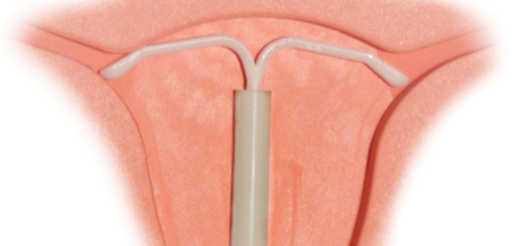 Ist es möglich, ein intrauterines Gerät für Nulliparous Frauen zu setzen