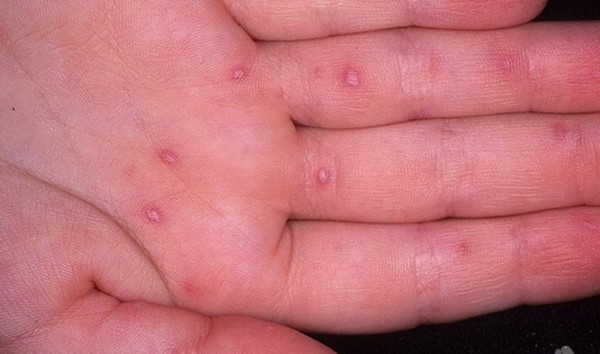 Hautausschlag bei Erwachsenen: Fotos, Ursachen von Hautausschlägen und Tipps zur Behandlung von Hautausschlägen