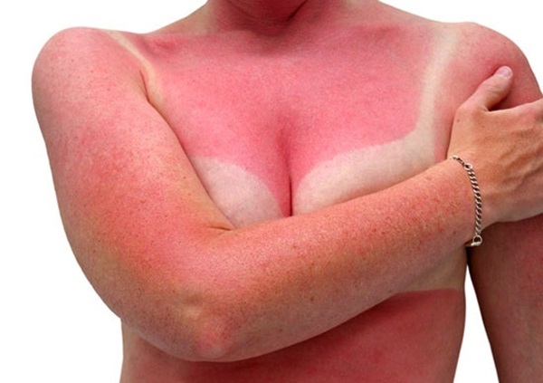 Sonnenbrand-Haut