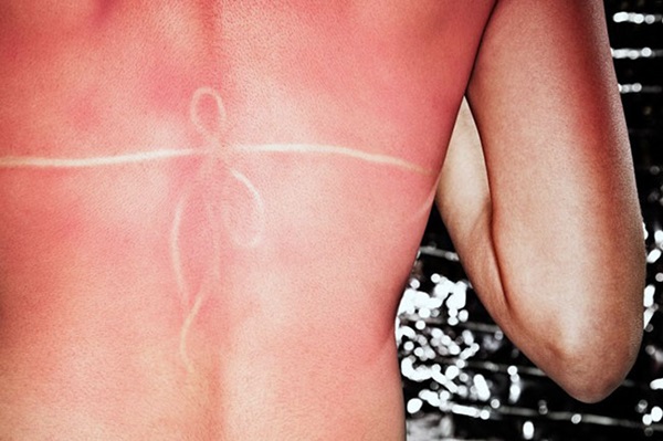Sonnenbrand-Haut