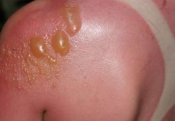 Sonnenbrand-Haut