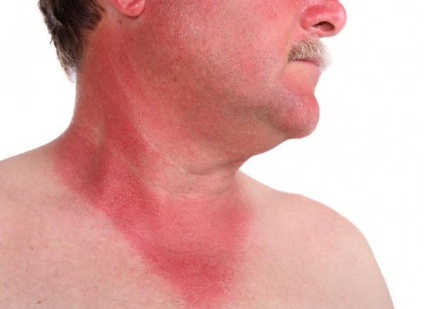 Sonnenbrand-Haut