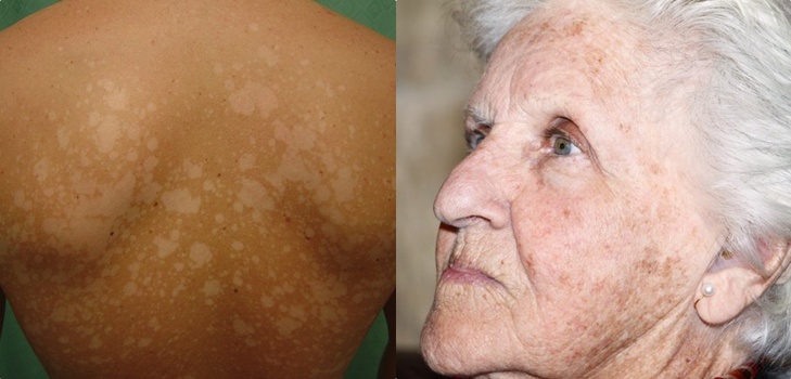 Auf der Haut ein Peeling