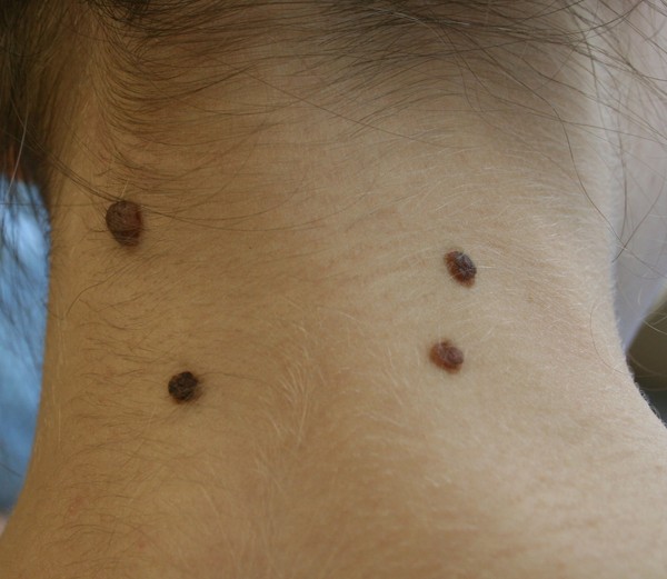 Auf der Haut ein Peeling
