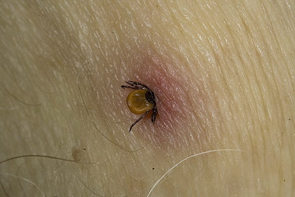 Insektenstiche