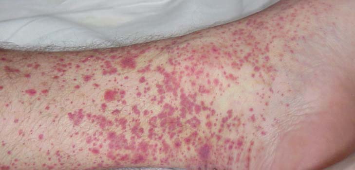 Vaskulitis - was ist das? Symptome, Fotos, Behandlung